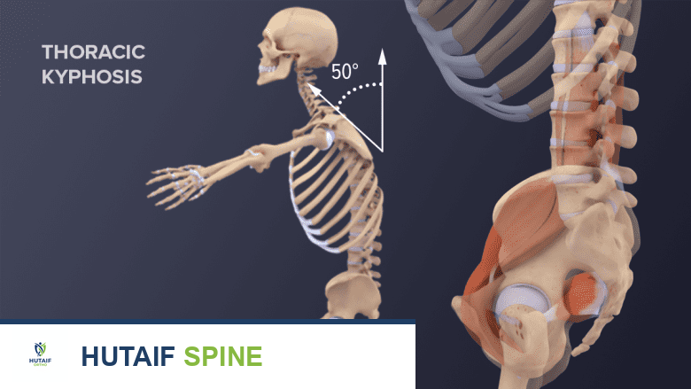 منظر جانبي للجسم بالكامل والحوض يظهر الحداب الظهري.