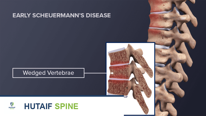 مرض شيرمان: فهم شامل للحداب الظهري والقطني لدى المراهقين والشباب