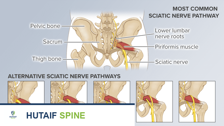 المسار الأكثر شيوعًا للعصب الوركي و 5 اختلافات تشريحية أخرى لمسار العصب.