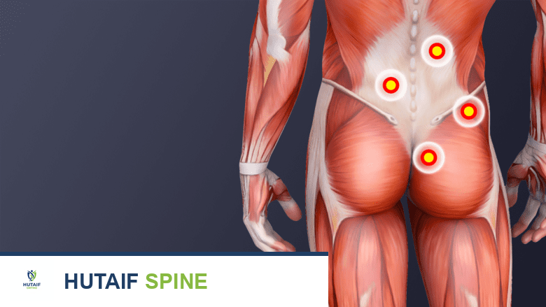صورة توضح نقاط الزناد في أسفل الظهر.