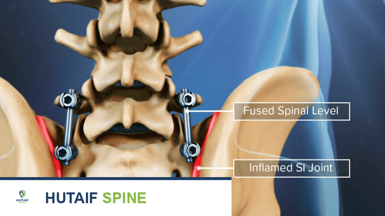 Illustration showing fused spinal level and inflamed SI joint.
