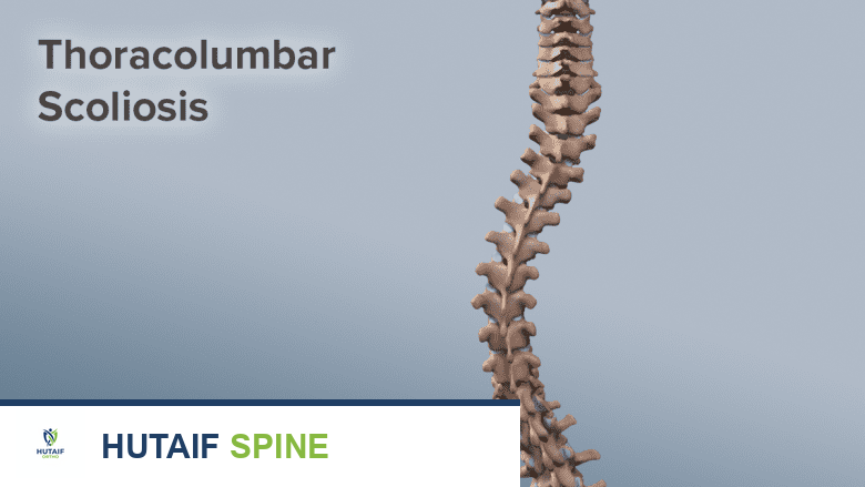 توضيح يظهر انحناءًا شديدًا في العمود الفقري.