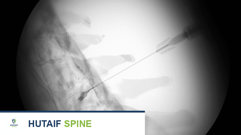 حقن منع جذور الأعصاب الانتقائية: دليل شامل لعلاج آلام الظهر والرقبة في صنعاء مع الأستاذ الدكتور محمد هطيف