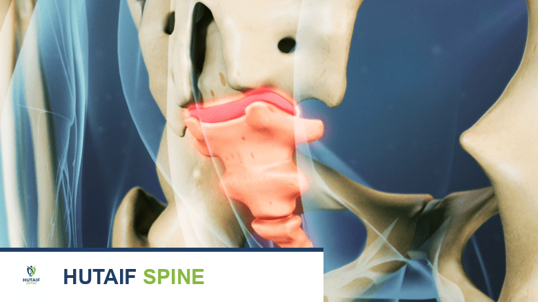 منظر خلفي لأربطة العصعص الملتهبة.