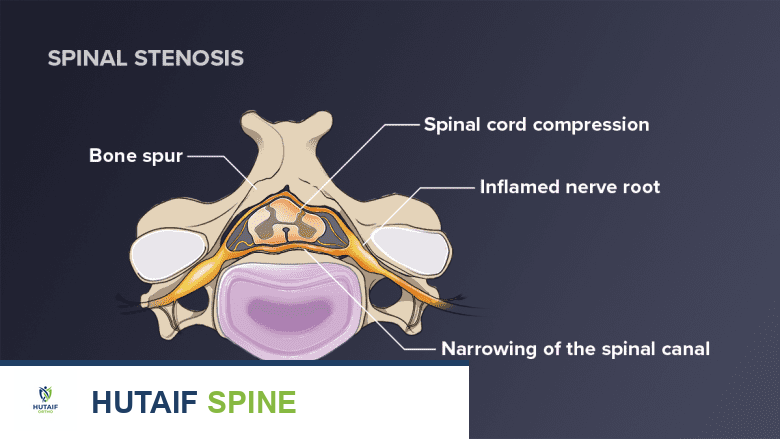 صورة توضيحية لـ تشريح الحبل الشوكي في الرقبة: دليلك الشامل للعناية بصحة عمودك الفقري مع الأستاذ الدكتور محمد هطيف