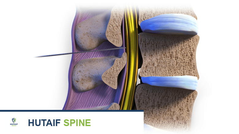 Sagittal view 3D cross section illustration of a lumbar epidural steroid injection.