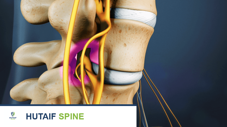 تضيق القناة الشوكية: دليلك الشامل لفهم وعلاج آلام الظهر والرقبة مع الأستاذ الدكتور محمد هطيف في صنعاء
