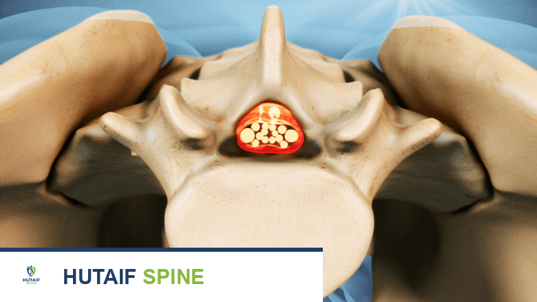 صورة توضيحية لـ مخاطر ومضاعفات عملية دمج الفقرات: دليل شامل للمرضى