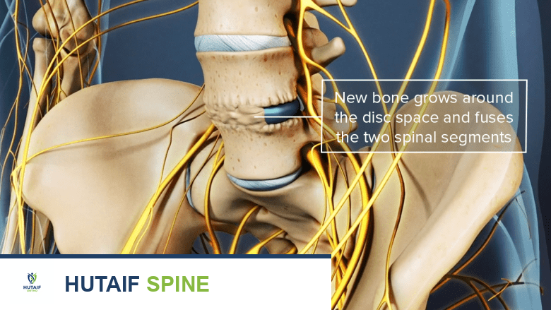 صورة توضيحية لـ مخاطر ومضاعفات عملية دمج الفقرات: دليل شامل للمرضى