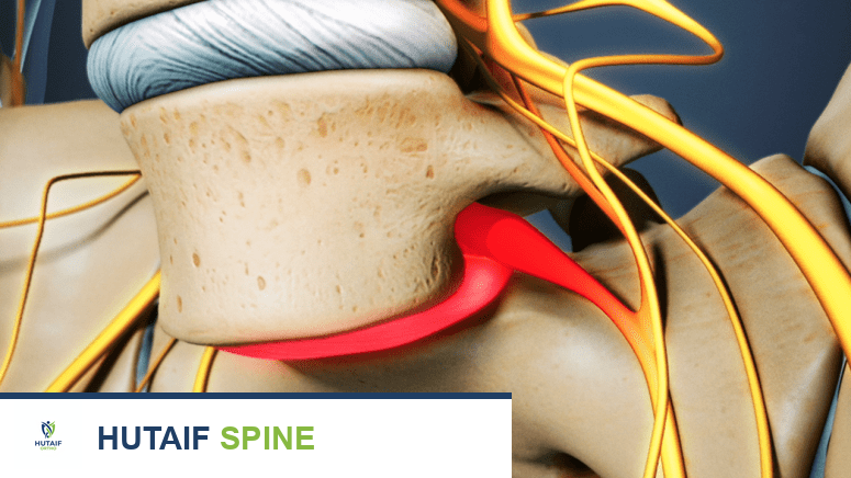 الانزلاق الفقاري: دليلك الشامل لفهم وعلاج هذه الحالة مع الأستاذ الدكتور محمد هطيف