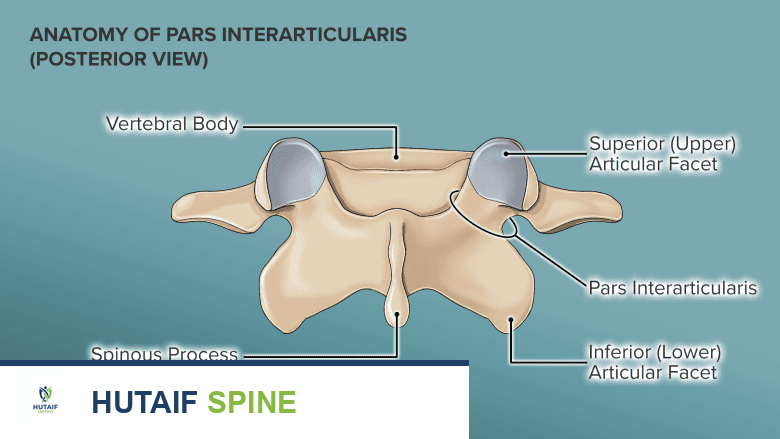 صورة توضيحية لـ انحلال الفقار والانزلاق الفقاري: دليلك الشامل مع الأستاذ الدكتور محمد هطيف