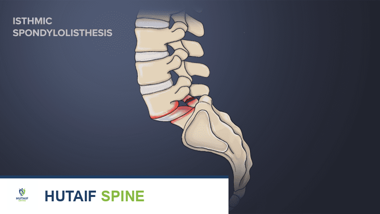 صورة توضيحية لـ انحلال الفقار والانزلاق الفقاري: دليلك الشامل مع الأستاذ الدكتور محمد هطيف