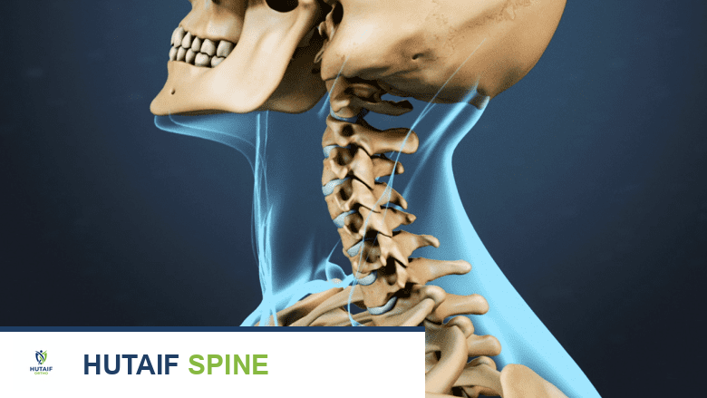 تصلب الرقبة الأسباب الأعراض والعلاج الشامل مع الأستاذ الدكتور محمد هطيف بصنعاء