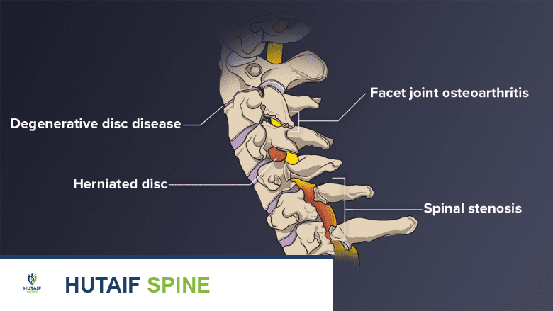 حالات قد تحدث في العمود الفقري العنقي بما في ذلك مرض القرص التنكسي والقرص المنفتق والتهاب المفاصل الوجيهي وتضيق العمود الفقري.