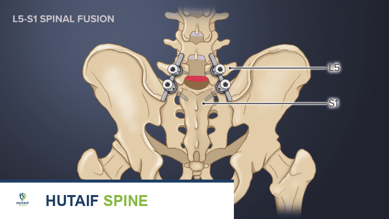 جراحة الانزلاق الغضروفي القطني التنكسي: دليل شامل للعلاج والتعافي مع الأستاذ الدكتور محمد هطيف