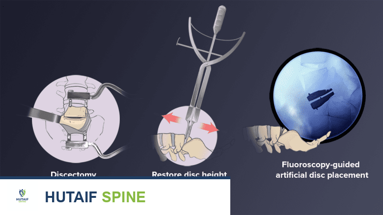 صورة توضيحية لـ جراحة الانزلاق الغضروفي القطني التنكسي: دليل شامل للعلاج والتعافي مع الأستاذ الدكتور محمد هطيف