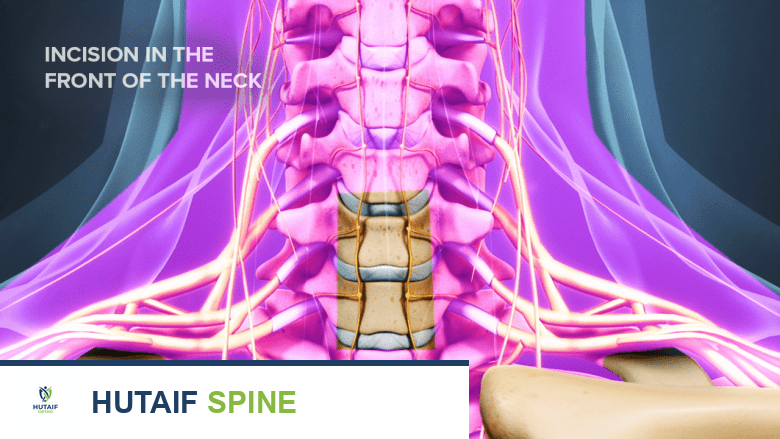 الخيارات الجراحية المتقدمة لعلاج انحلال القرص العنقي التنكسي: دليل شامل