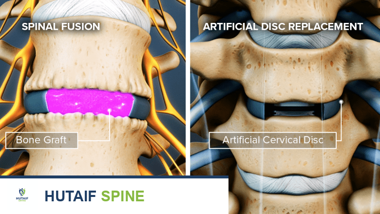 صورة توضيحية لدمج الفقرات واستبدال القرص الصناعي.