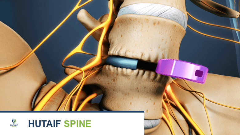 جراحات علاج مرض القرص التنكسي: دليل شامل لاستعادة حياتك مع الأستاذ الدكتور محمد هطيف