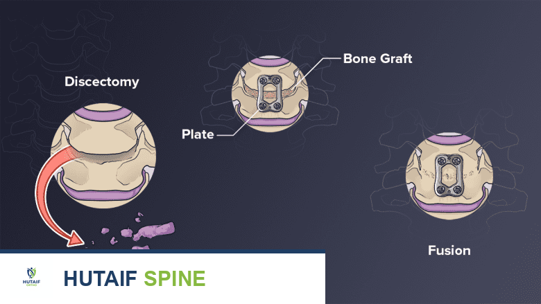 صورة توضيحية لـ جراحات علاج مرض القرص التنكسي: دليل شامل لاستعادة حياتك مع الأستاذ الدكتور محمد هطيف