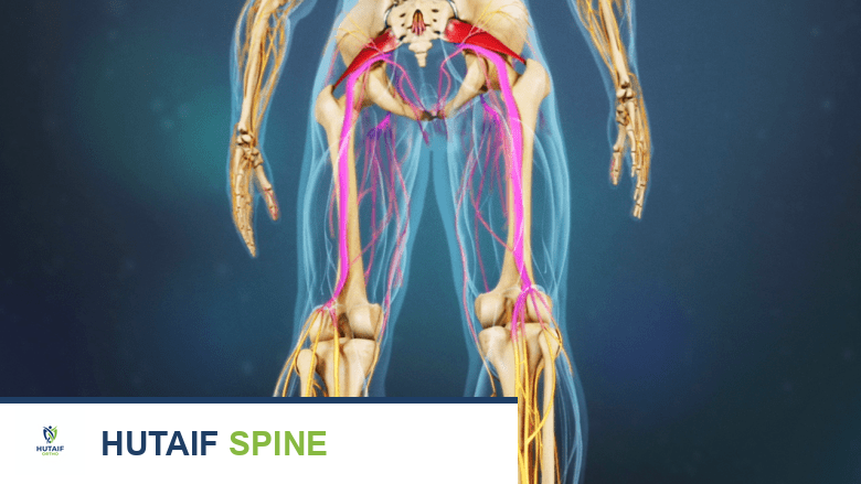 An illustration showing piriformis syndrome pain radiating from buttock down the legs.