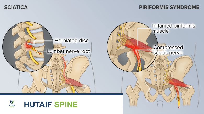An illustration showing origin of pain in sciatica vs Piriformis Syndrome.
