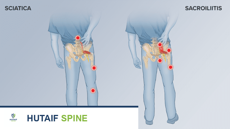 2 Illustrations of a man holding his lower back. Red dots indicate pain areas. Left to right. Sciatica and SI joint pain.