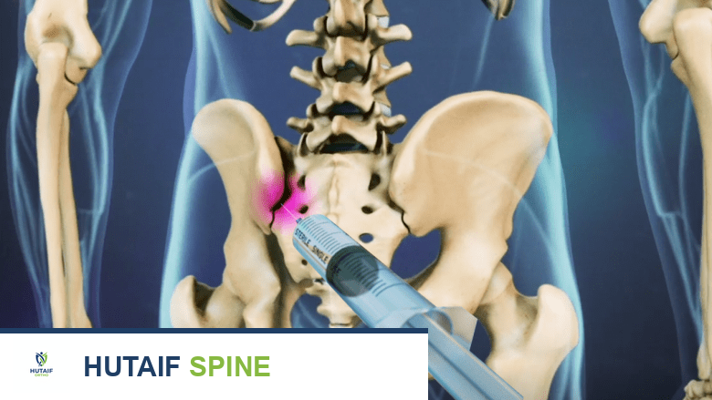 3D rendering of a syringe with a needle place in the SI joint of the human pelvis.