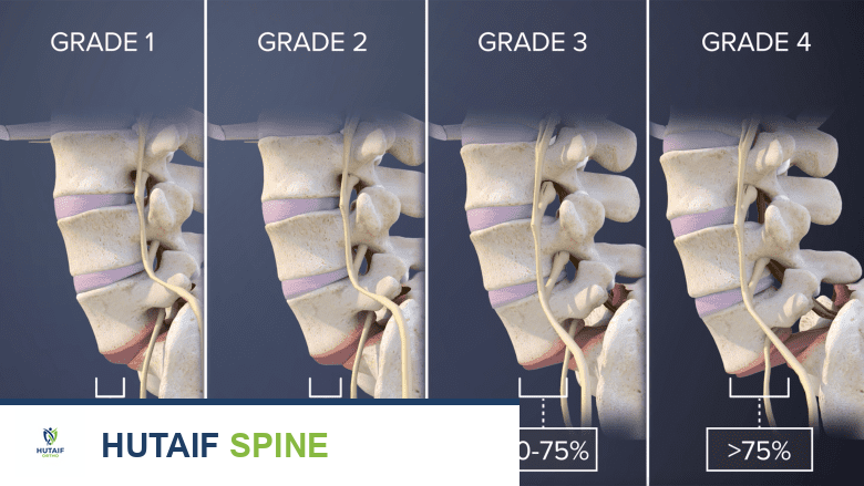 توضيح يظهر درجات الانزلاق الفقاري البرزخي.