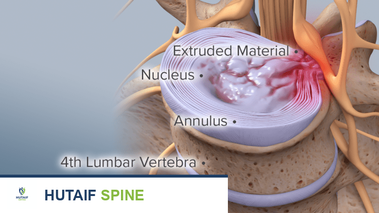 التسلسل التنكسي للقرص الفقري: فهم شامل لأسباب وأعراض وعلاج انزلاق وتآكل الغضاريف مع الأستاذ الدكتور محمد هطيف