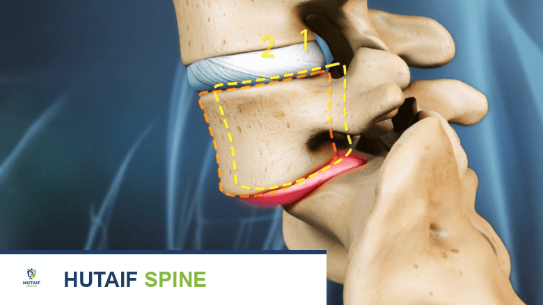دمج الفقرات متعدد المستويات: دليلك الشامل لاستعادة استقرار العمود الفقري