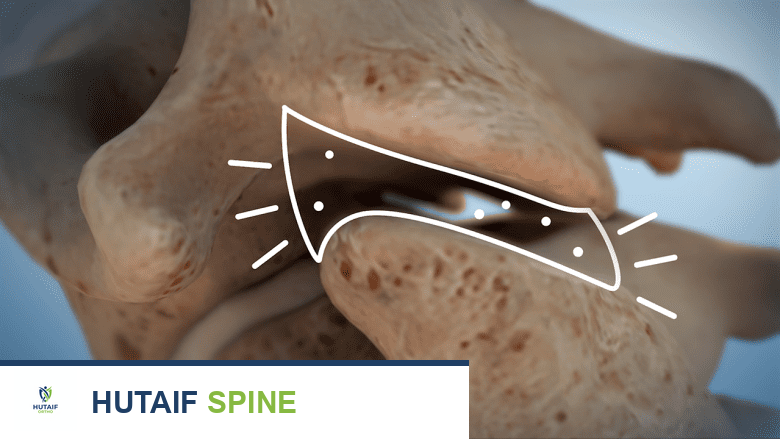 حقيقة طقطقة الظهر وطحن الفقرات: متى تكون طبيعية ومتى تستدعي القلق؟ دليل شامل من الأستاذ الدكتور محمد هطيف في صنعاء