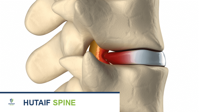 صورة توضيحية لـ أقراص الظهر الصدرية: دليل شامل لفهم الألم والعلاج مع الأستاذ الدكتور محمد هطيف