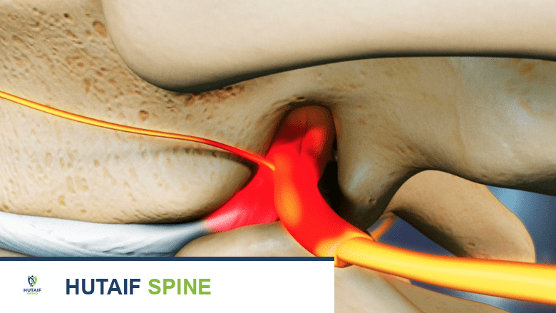 تصوير ثلاثي الأبعاد سهمي لقرص منفتق يضغط على عصب شوكي.