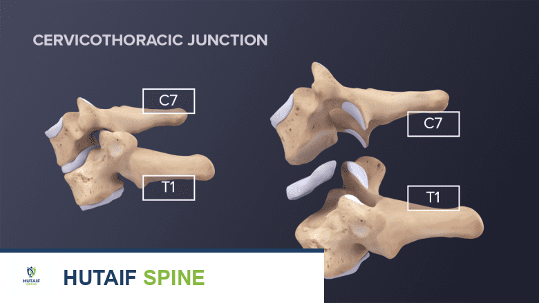 رسم توضيحي للفقرات C7-T1 وتسمى أيضًا الوصلة العنقية الصدرية