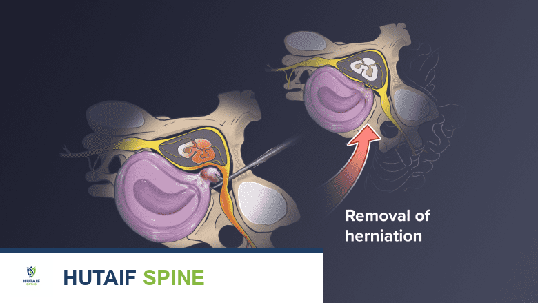 Illustration showing removal of herniated disc.