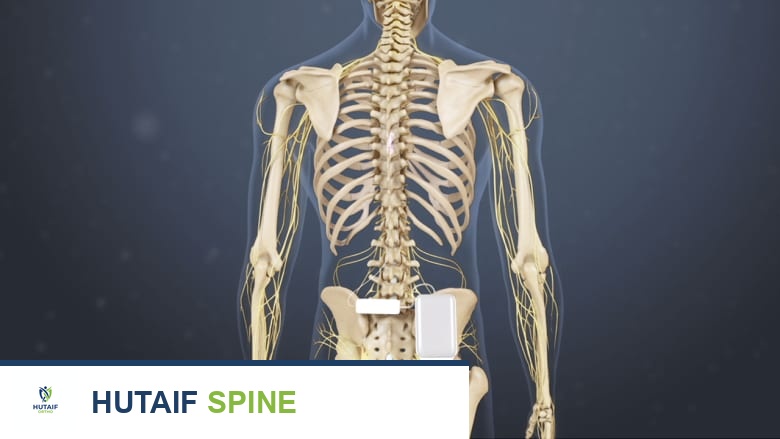 زرع محفز الحبل الشوكي في أسفل الظهر