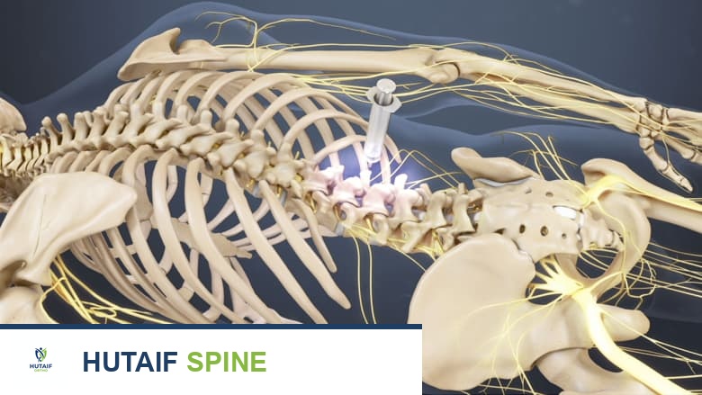 حقنة في العمود الفقري