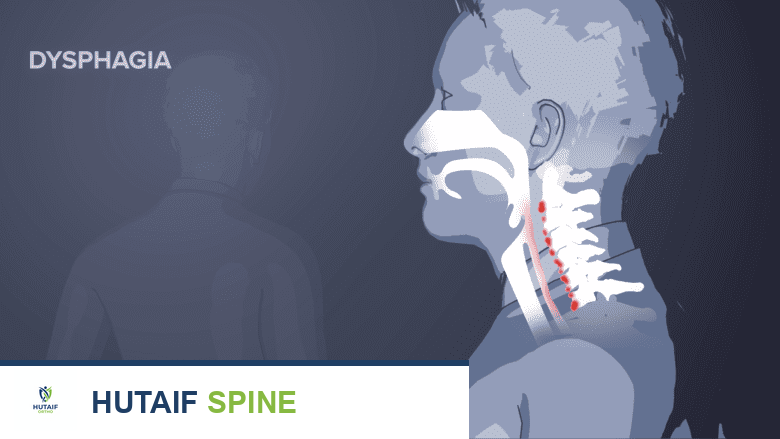 صعوبة بلع الحبوب عسر البلع وتأثيره على علاج آلام الظهر والرقبة