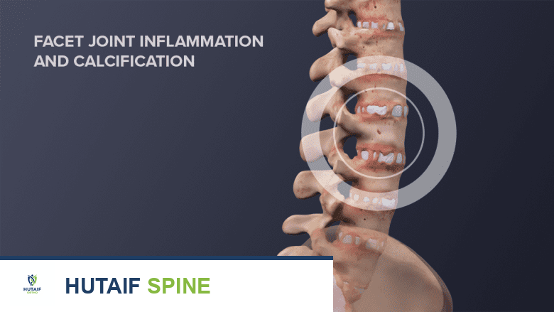 رسم توضيحي للعمود الفقري الفقري مع التهاب وتكلس المفاصل الوجهية.