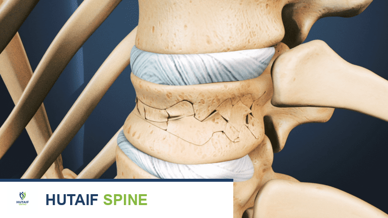 توضيح لفقرة مصابة بكسر.