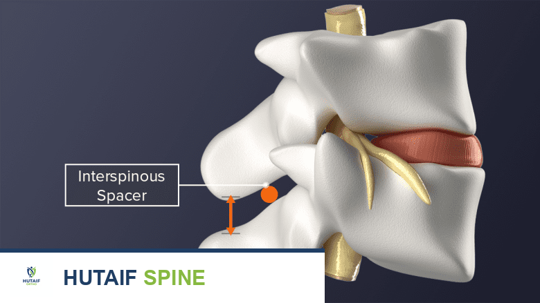 توضيح مباعد بين النواتئ الشوكية يظهر استعادة ارتفاع القرص بين فقرتين.
