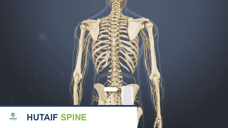 وحدة تحفيز الحبل الشوكي والأسلاك في العمود الفقري.