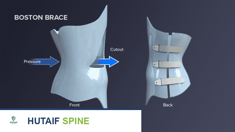 الجنف (اعوجاج العمود الفقري): دليل شامل لأنواعه، أعراضه، تشخيصه، وخيارات العلاج المتاحة، مع التركيز على دعامات الظهر