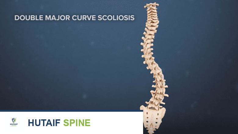 توضيح يظهر جنفًا منحنيًا مزدوجًا.