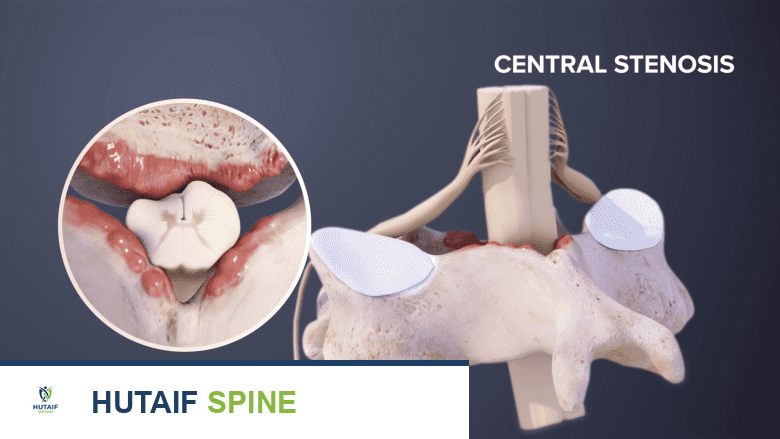 توضيح ثلاثي الأبعاد لتضيق القناة الشوكية المركزية من الأعلى والجانب.
