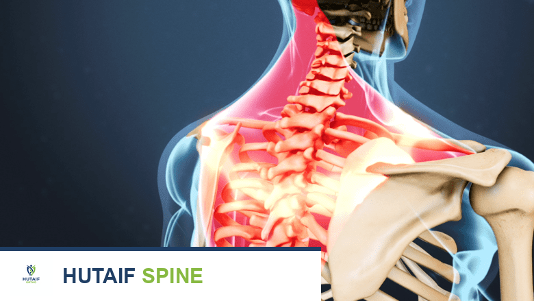 رسم توضيحي طبي يظهر ألم الرقبة المشع إلى الكتف باللون الأحمر.