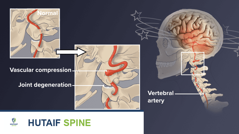 رسم توضيحي طبي يظهر الدوخة وألم الرقبة.