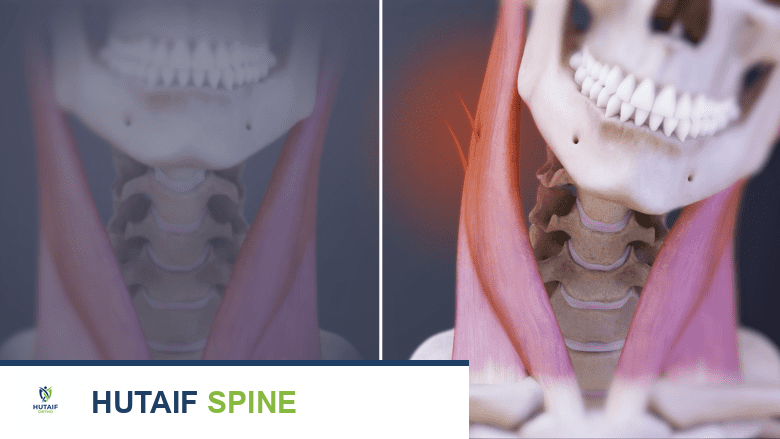 تشنجات الرقبة: دليل شامل لفهم الأسباب، الأعراض، وخيارات العلاج المتطورة مع الأستاذ الدكتور محمد هطيف
