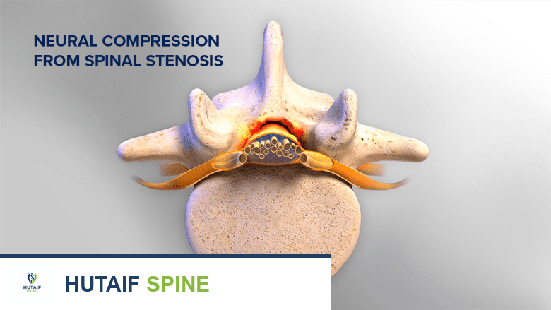 توضيح يظهر عمودًا فقريًا قطنيًا مع تضيق القناة الشوكية.